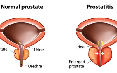 Prostatitis: What Is It & Can Pelvic PT Help?