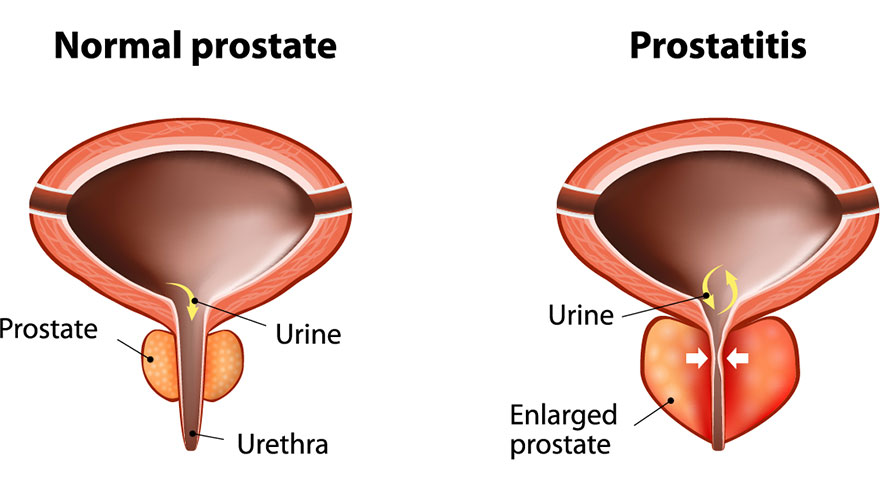 Prostatitis: What Is It & Can Pelvic PT Help?